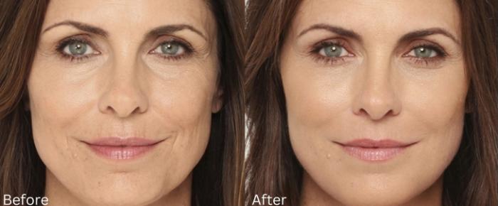 Before & After Radiesse Filler Case 313 View 1 View in Santa Rosa, California