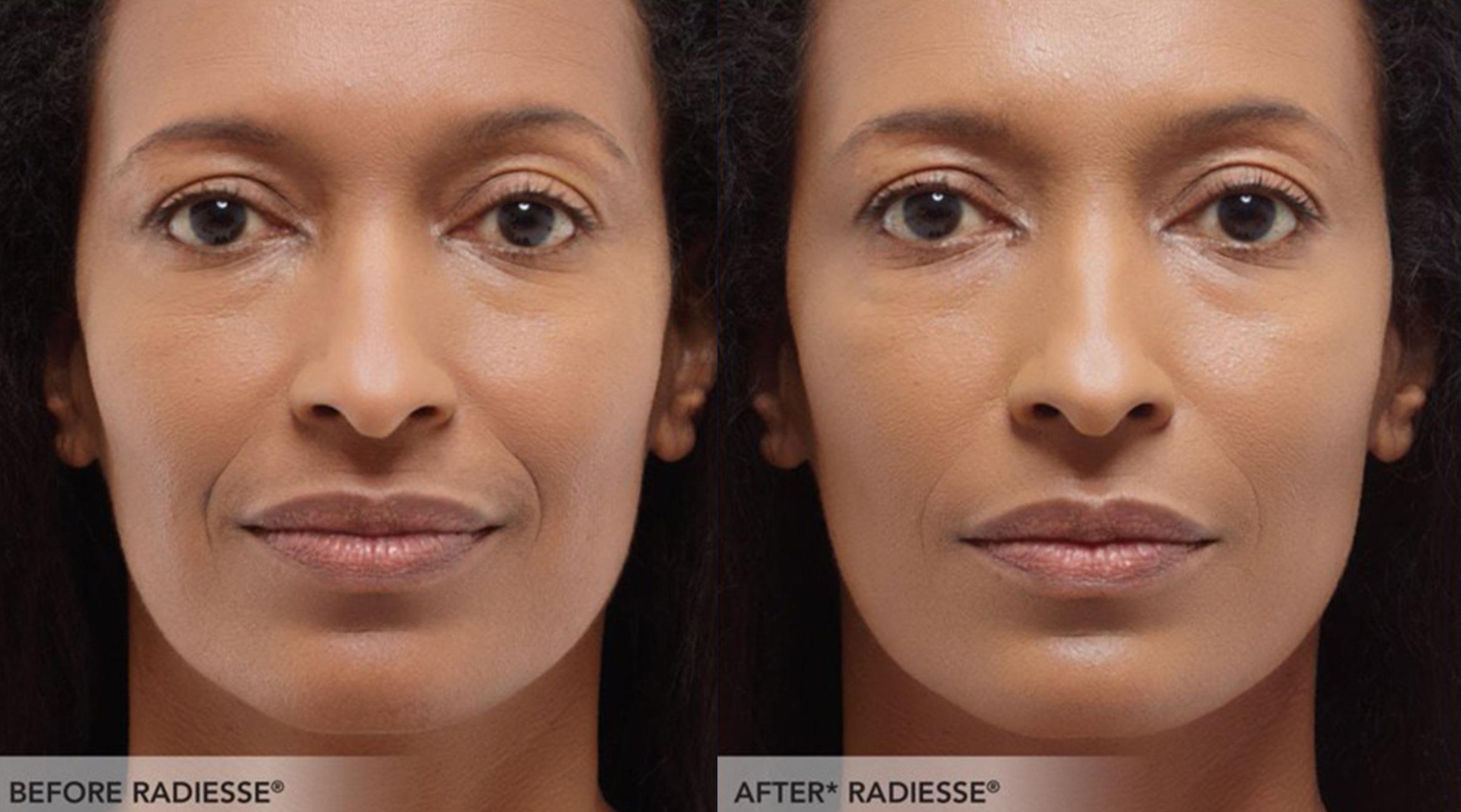 Before & After Radiesse Filler Case 314 View 1 View in Santa Rosa, California