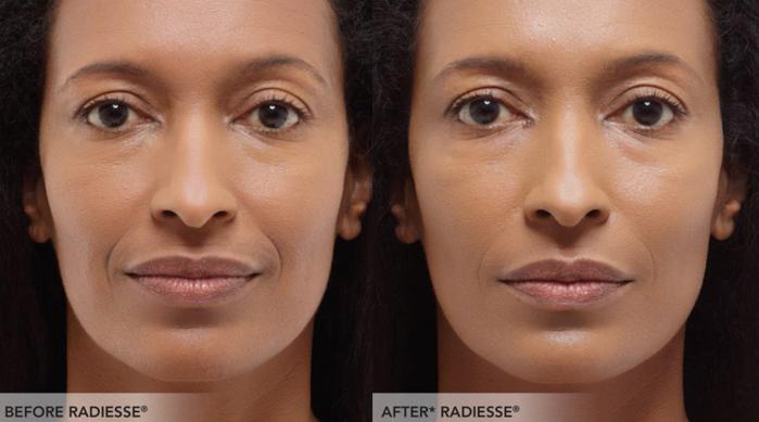 Before & After Radiesse Filler Case 314 View 1 View in Santa Rosa, California
