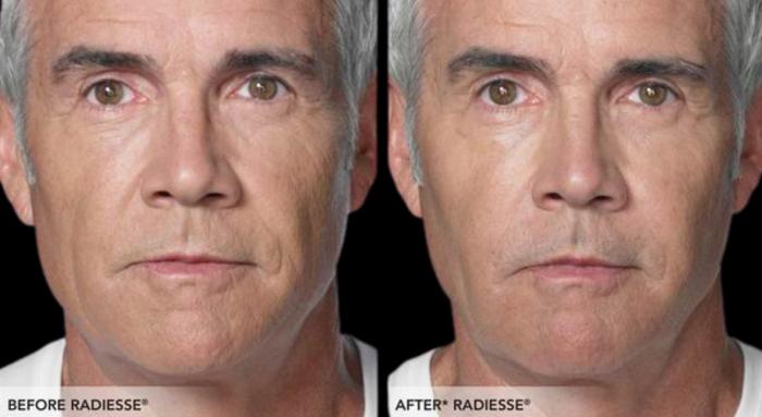 Before & After Radiesse Filler Case 315 View 1 View in Santa Rosa, California