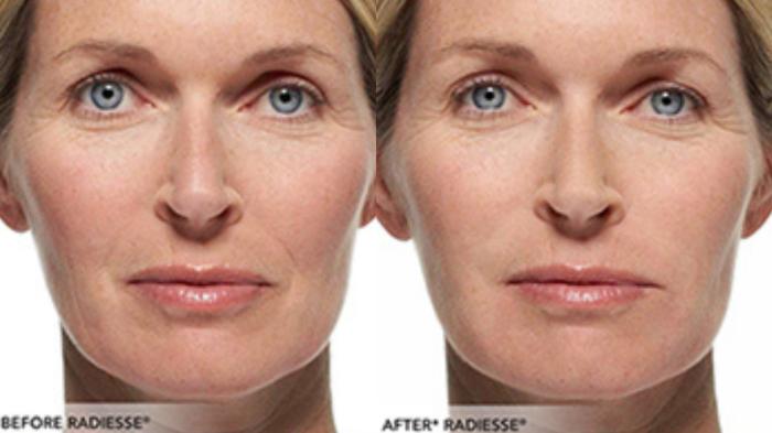 Before & After Radiesse Filler Case 316 View 1 View in Santa Rosa, California