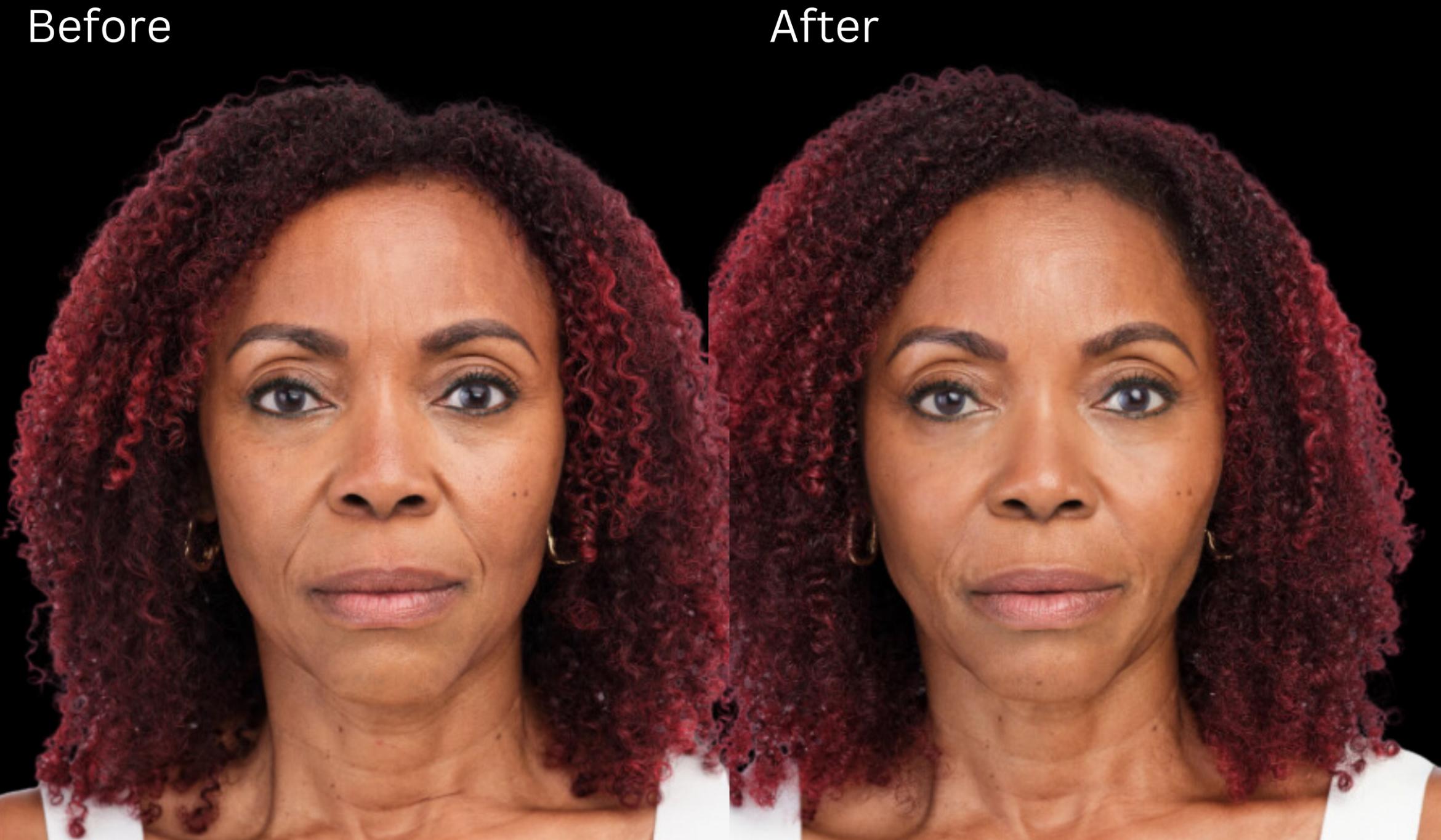 Before & After Radiesse Filler Case 317 View 1 View in Santa Rosa, California