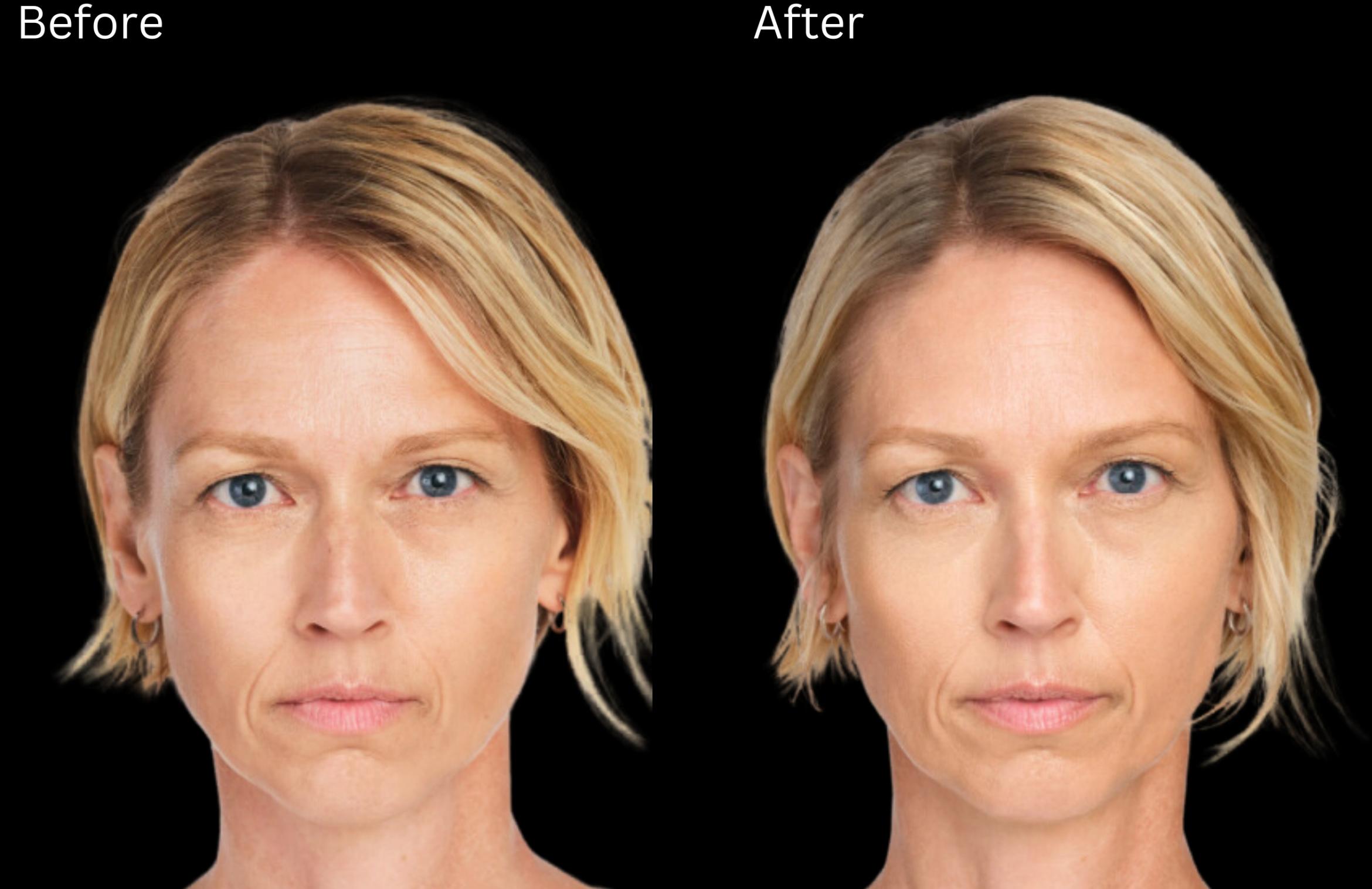 Before & After Radiesse Filler Case 318 View 1 View in Santa Rosa, California