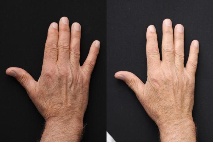 Before & After Radiesse Filler Case 376 View 1 View in Santa Rosa, California