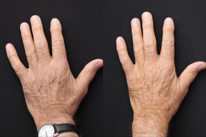 Before & After Radiesse Filler Case 376 View 2 View in Santa Rosa, California