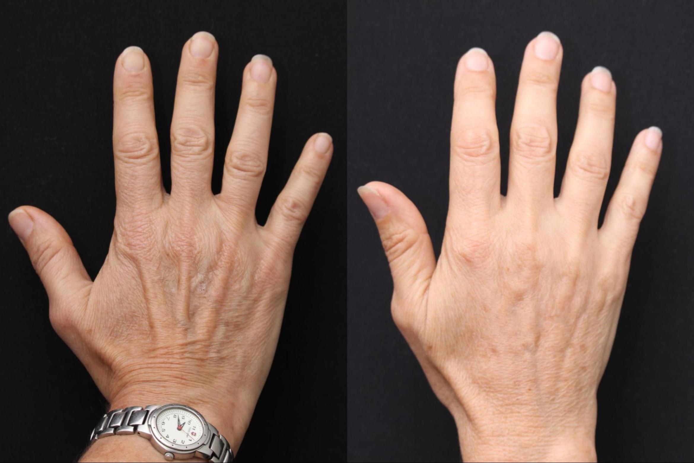Before & After Radiesse Filler Case 377 View 1 View in Santa Rosa, California