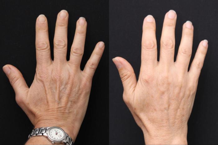 Before & After Radiesse Filler Case 377 View 1 View in Santa Rosa, California