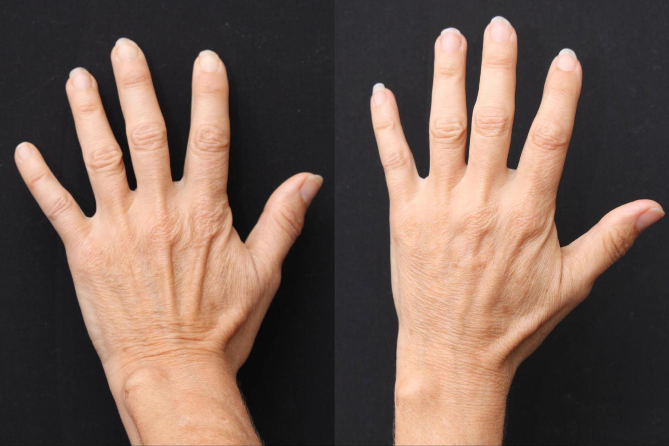 Before & After Radiesse Filler Case 377 View 2 View in Santa Rosa, California