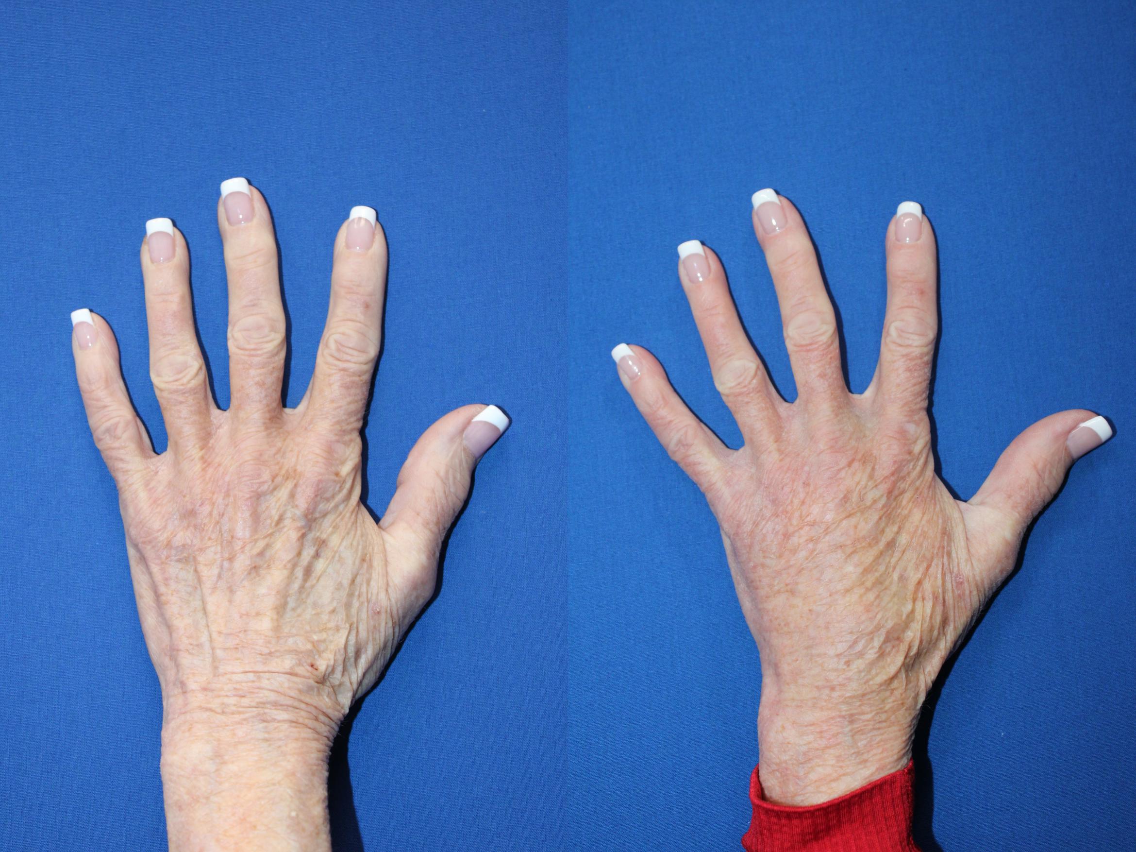 Before & After Radiesse Filler Case 421 Left Side View in Santa Rosa, California
