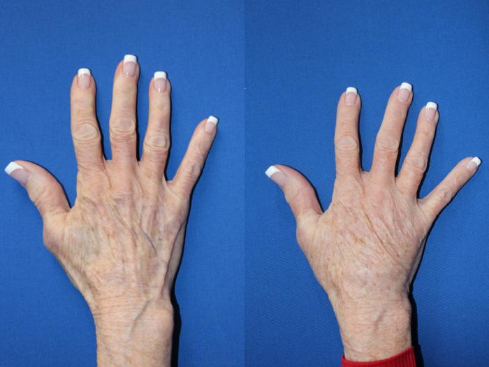 Before & After Radiesse Filler Case 421 Right Side View in Santa Rosa, California
