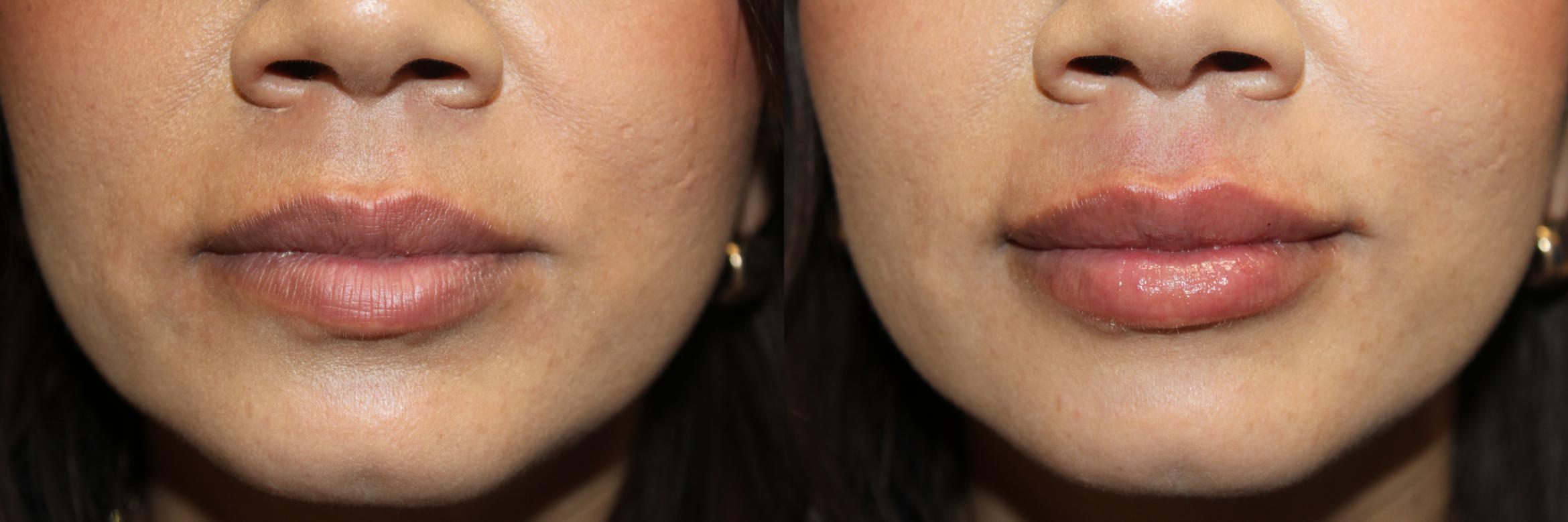 Before & After RHA Collection Case 425 Front View in Santa Rosa, California