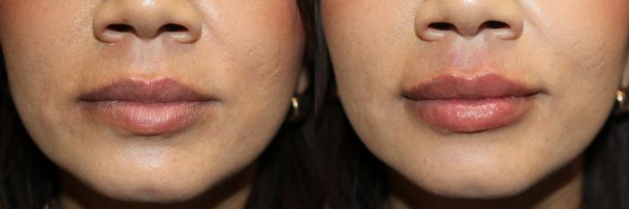 Before & After RHA Collection Case 425 Front View in Santa Rosa, California