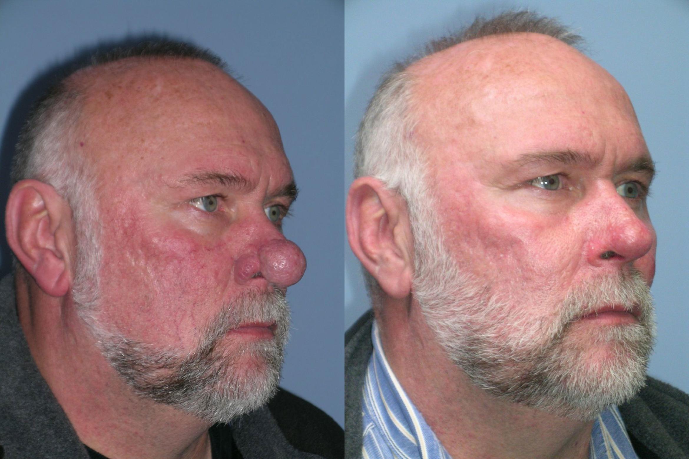 Before & After Rhinophyma Case 260 View 1 View in Santa Rosa, California