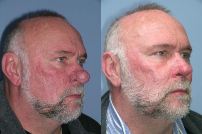 Before & After Rhinophyma Case 260 View 1 View in Santa Rosa, California