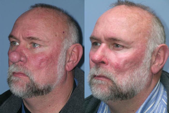 Before & After Rhinophyma Case 260 View 2 View in Santa Rosa, California