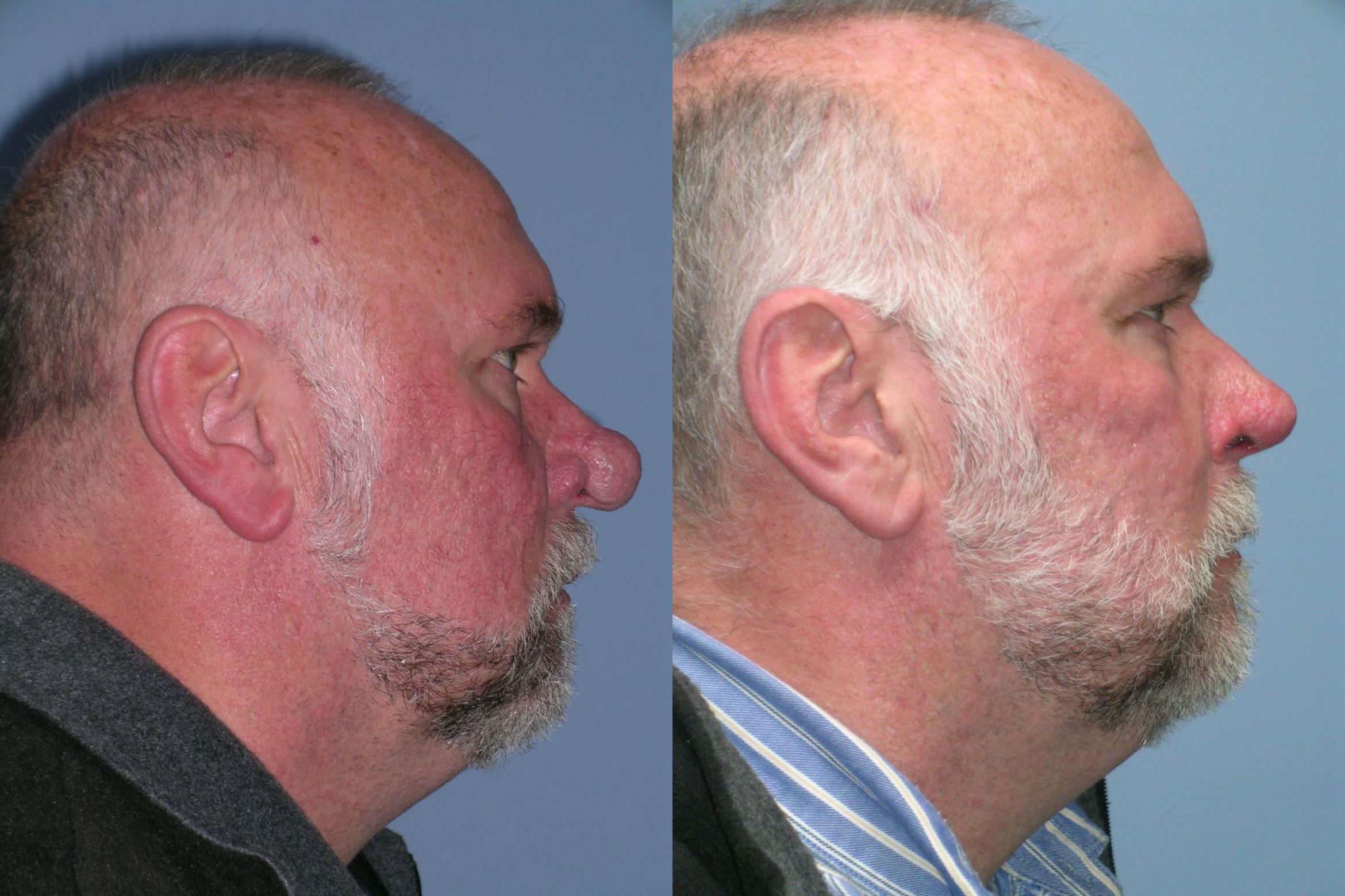 Before & After Rhinophyma Case 260 View 3 View in Santa Rosa, California
