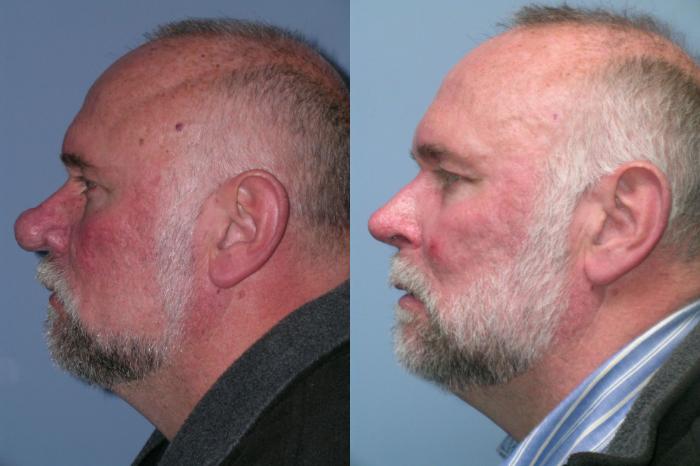 Before & After Rhinophyma Case 260 View 4 View in Santa Rosa, California