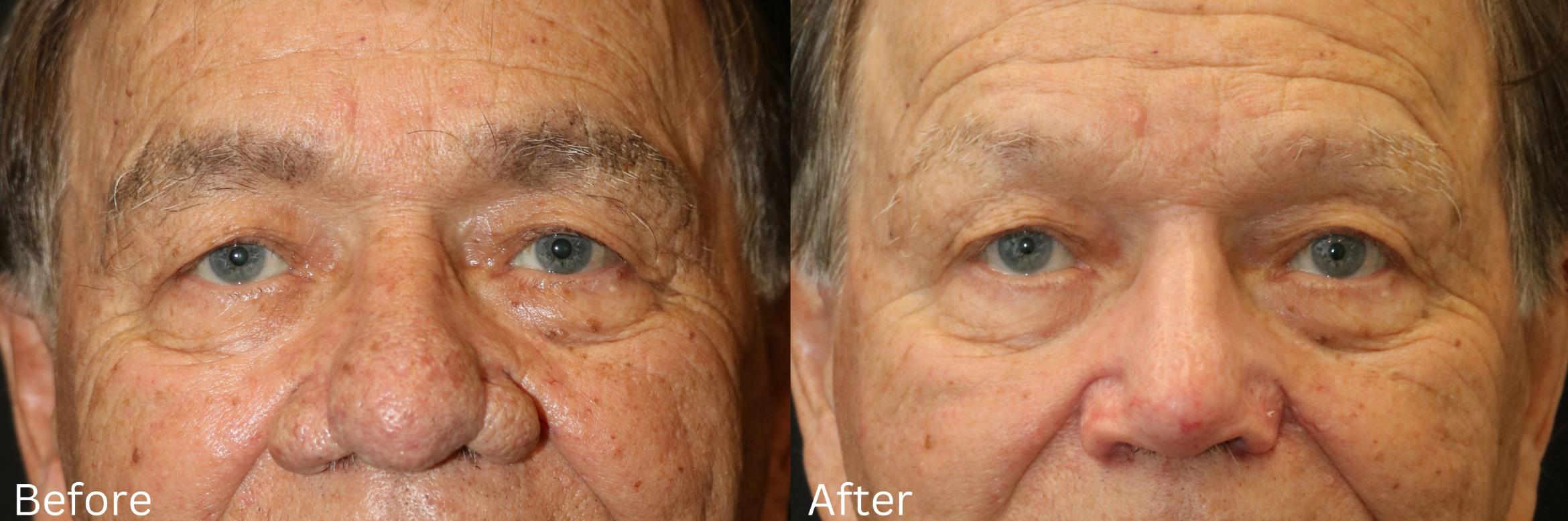 Before & After Rhinophyma Case 369 View 1 View in Santa Rosa, California