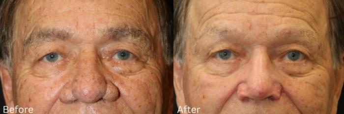 Before & After Rhinophyma Case 369 View 1 View in Santa Rosa, California