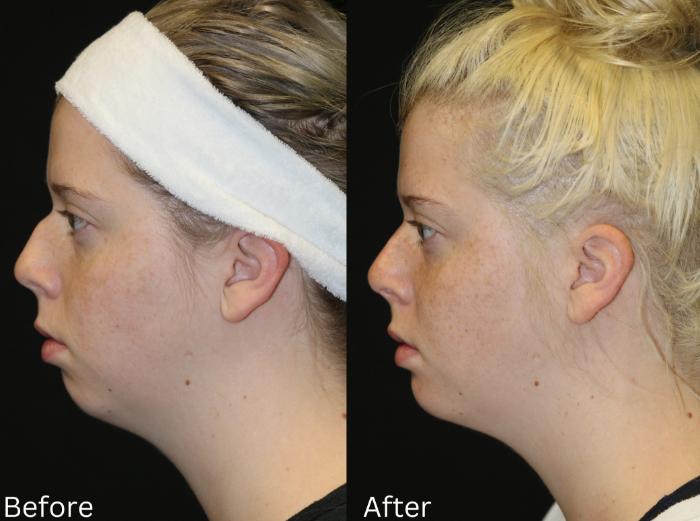 Before & After Rhinoplasty & Septoplasty Case 176 View 1 View in Santa Rosa, California
