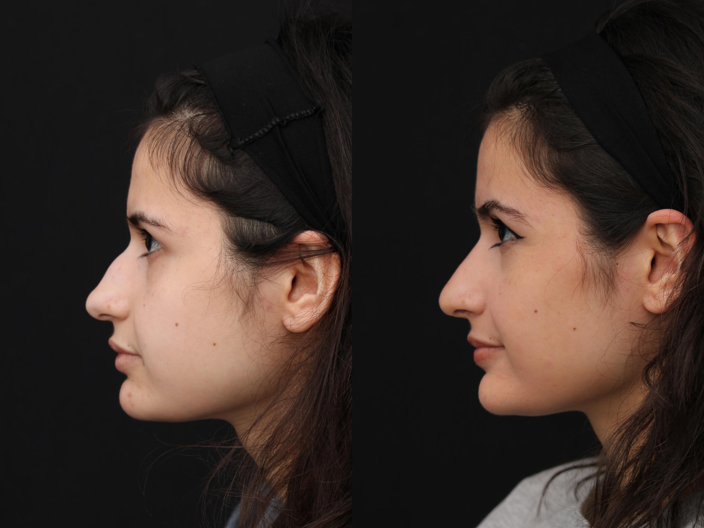Before & After Rhinoplasty & Septoplasty Case 422 Left Side View in Santa Rosa, California