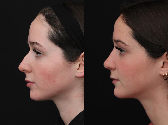 Before & After Rhinoplasty & Septoplasty Case 423 Left Side View in Santa Rosa, California