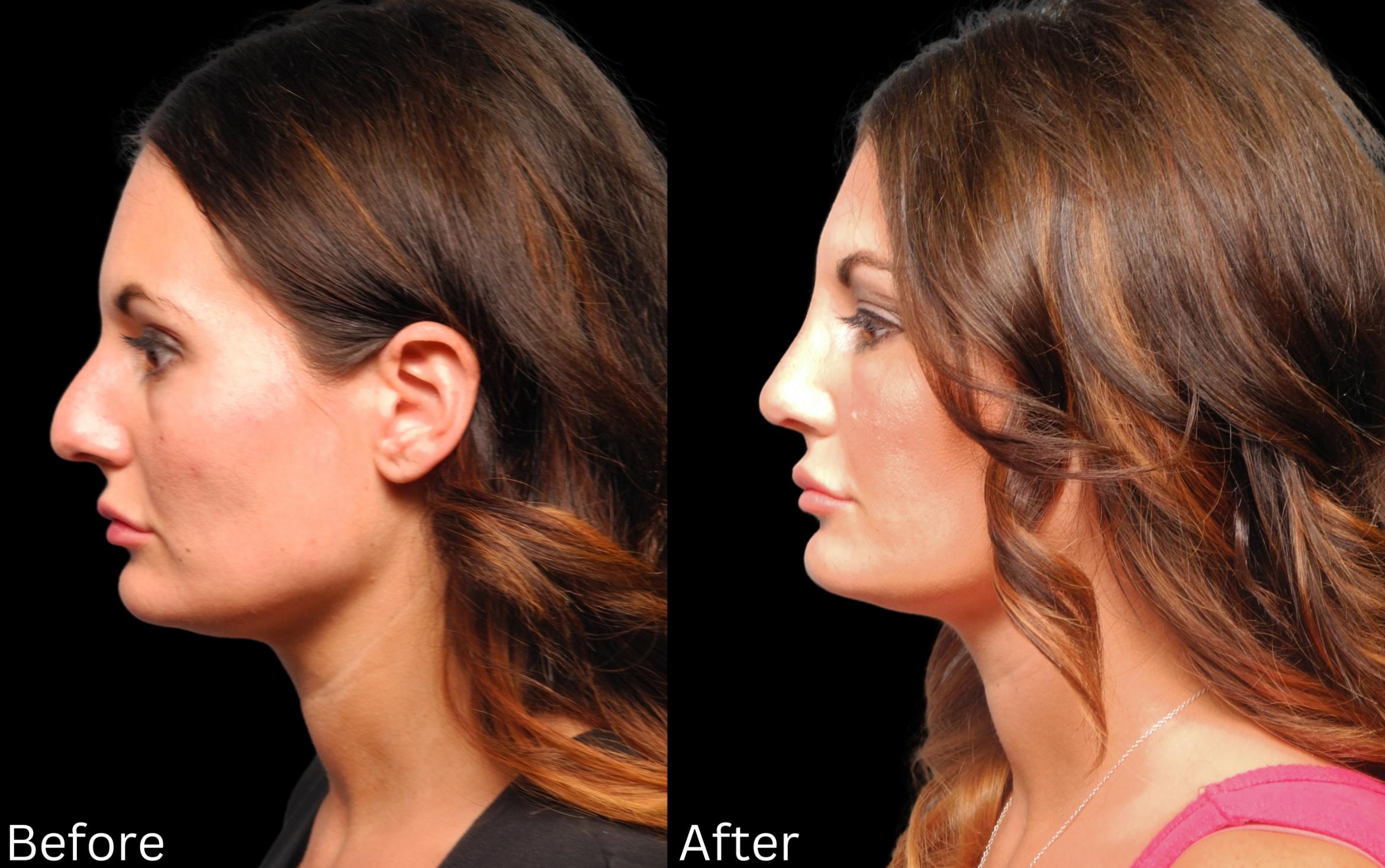 Before & After Rhinoplasty & Septoplasty Case 68 View 1 View in Santa Rosa, California