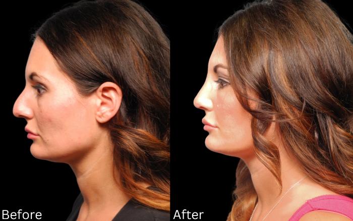 Before & After Rhinoplasty & Septoplasty Case 68 View 1 View in Santa Rosa, California