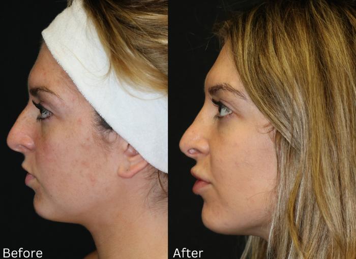 Before & After Rhinoplasty & Septoplasty Case 69 View 1 View in Santa Rosa, California