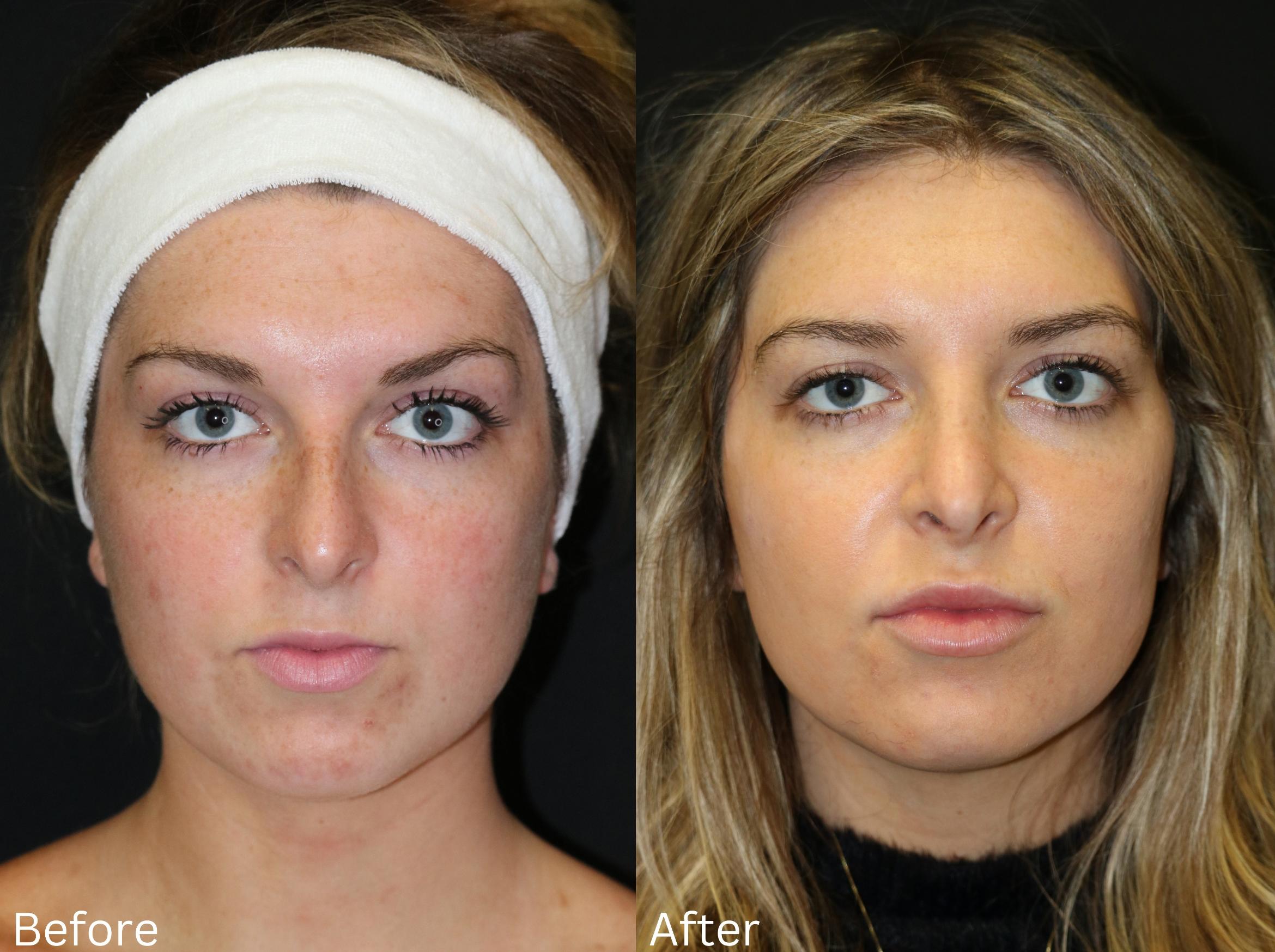 Before & After Rhinoplasty & Septoplasty Case 69 View 2 View in Santa Rosa, California