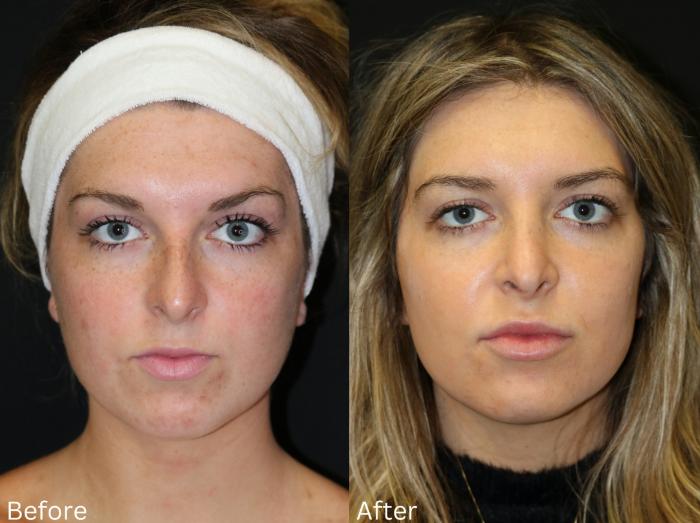Before & After Rhinoplasty & Septoplasty Case 69 View 2 View in Santa Rosa, California