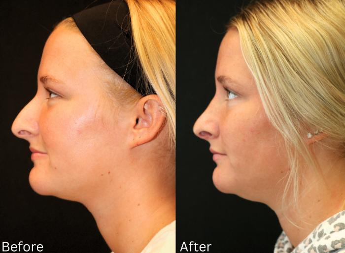 Before & After Rhinoplasty & Septoplasty Case 70 View 1 View in Santa Rosa, California