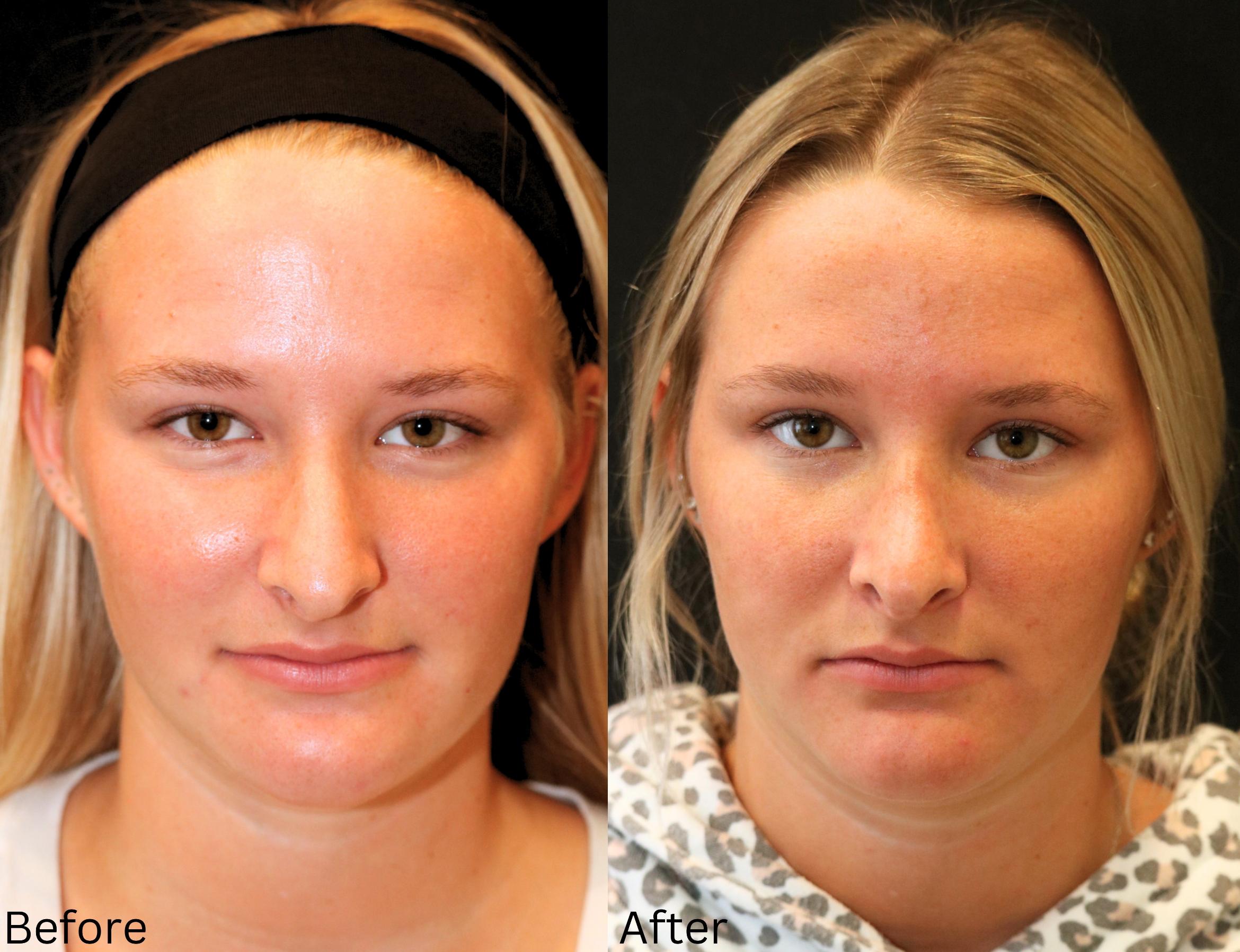 Before & After Rhinoplasty & Septoplasty Case 70 View 2 View in Santa Rosa, California