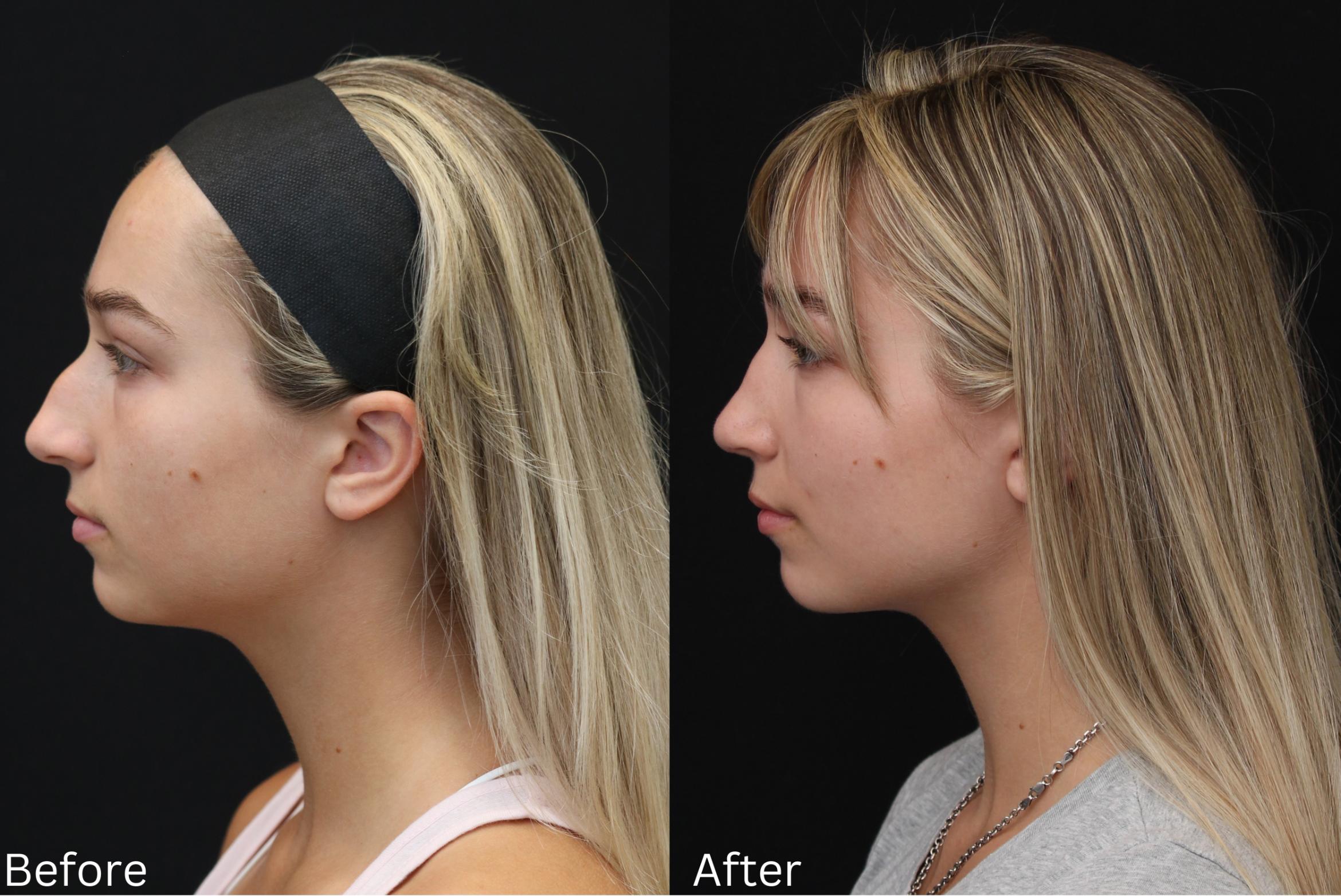 Before & After Rhinoplasty & Septoplasty Case 71 View 1 View in Santa Rosa, California
