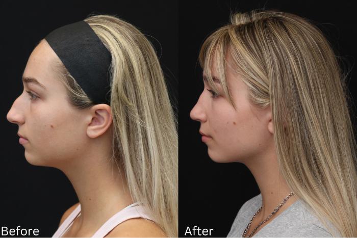 Before & After Rhinoplasty & Septoplasty Case 71 View 1 View in Santa Rosa, California