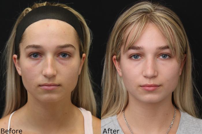 Before & After Rhinoplasty & Septoplasty Case 71 View 2 View in Santa Rosa, California