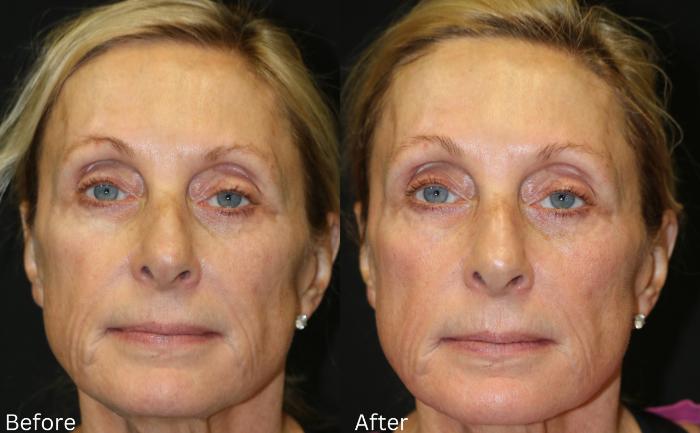 Before & After SaltFacial Case 144 View 1 View in Santa Rosa, California
