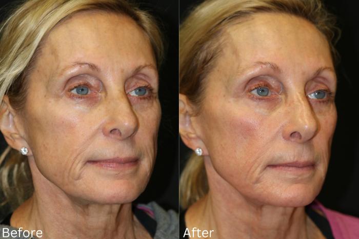 Before & After SaltFacial Case 144 View 2 View in Santa Rosa, California