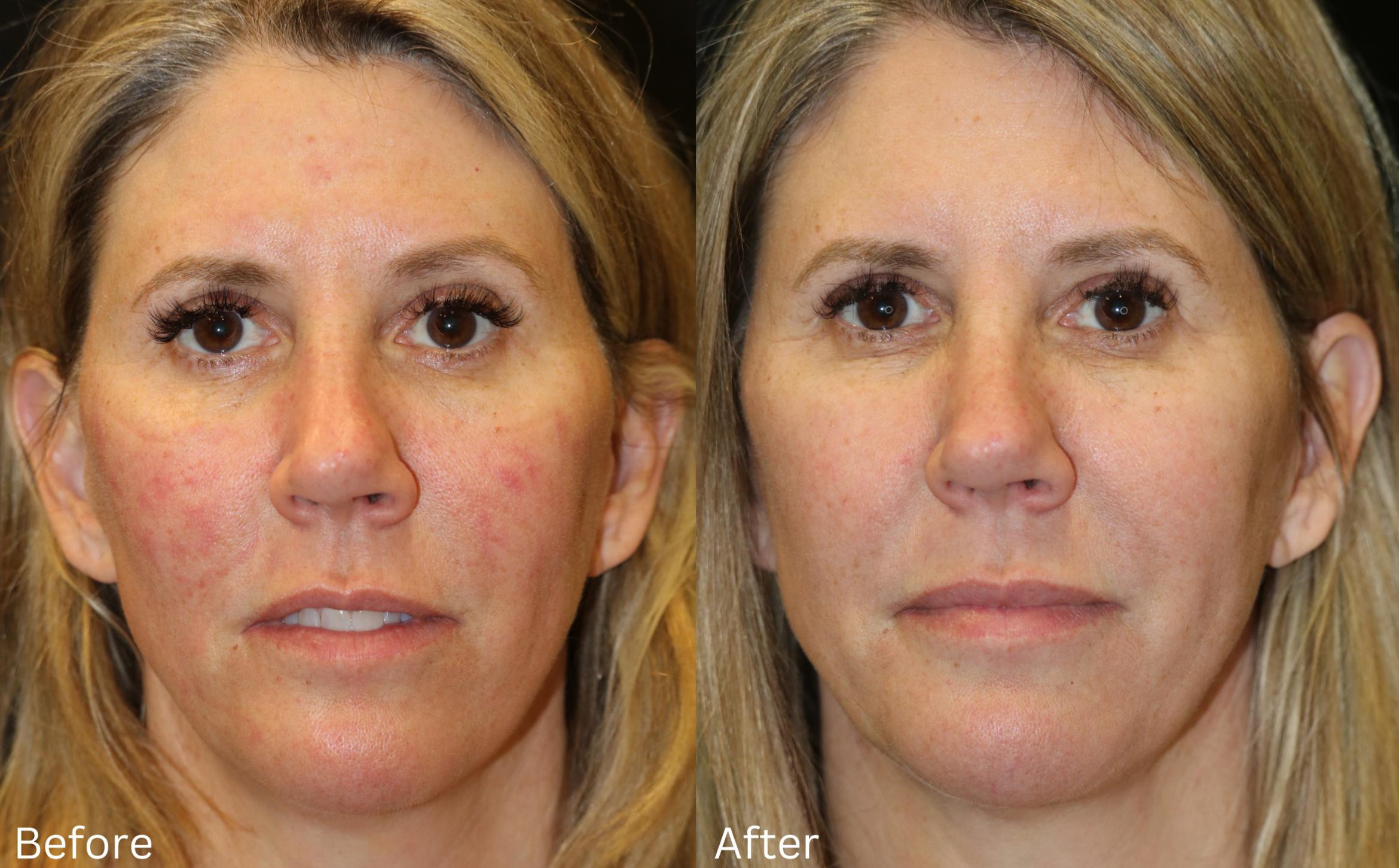 Before & After SaltFacial Case 145 View 1 View in Santa Rosa, California