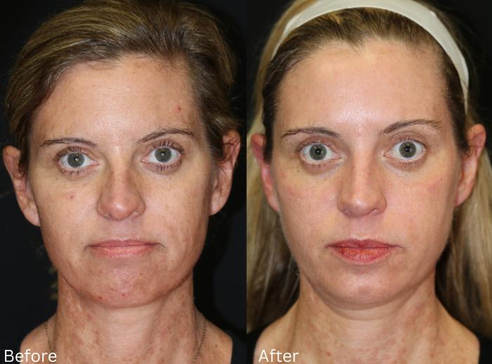 Before & After SaltFacial Case 146 View 1 View in Santa Rosa, California