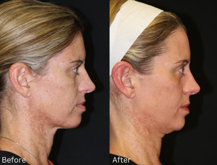 Before & After SaltFacial Case 146 View 2 View in Santa Rosa, California