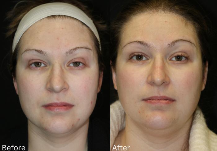 Before & After SaltFacial Case 229 View 1 View in Santa Rosa, California