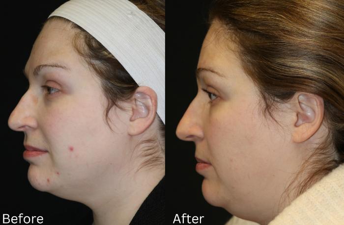 Before & After SaltFacial Case 229 View 2 View in Santa Rosa, California