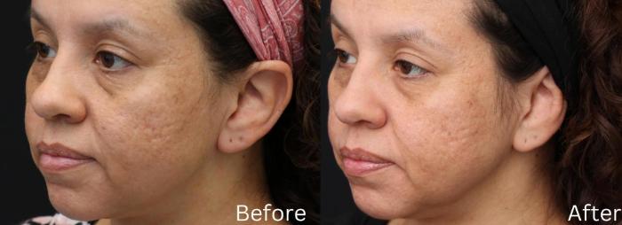 Before & After Scar Therapy Case 147 View 1 View in Santa Rosa, California