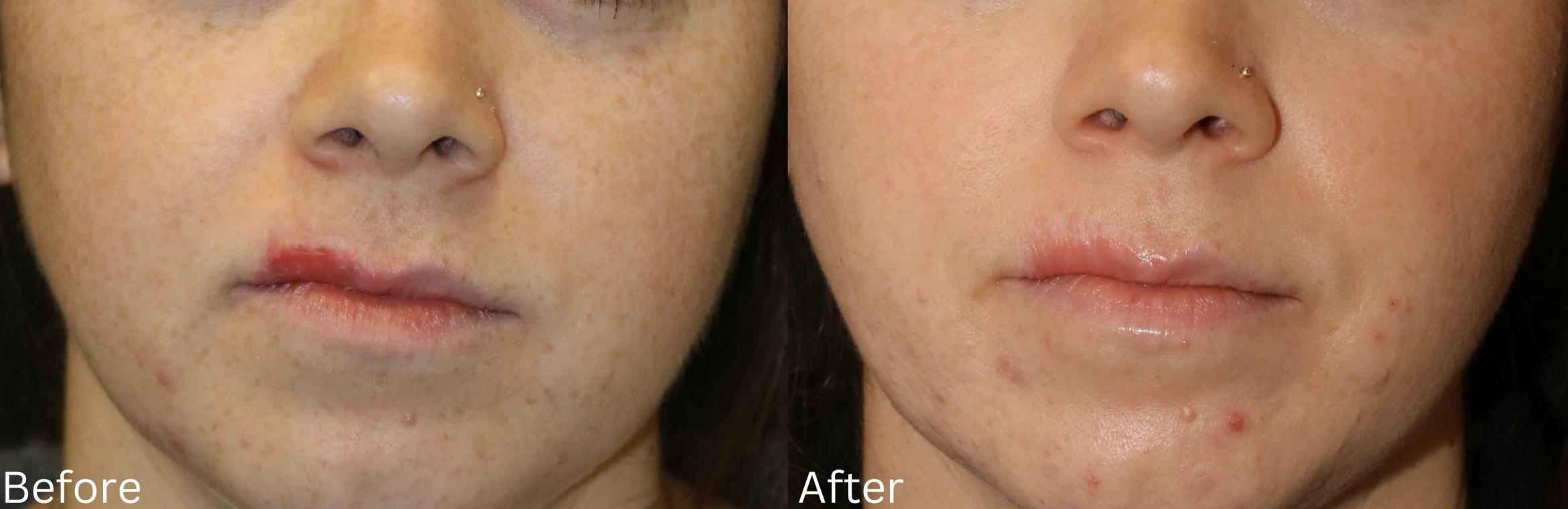 Before & After Scar Therapy Case 232 View 1 View in Santa Rosa, California