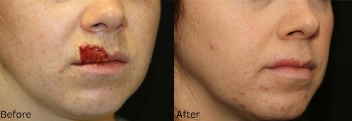Before & After Scar Therapy Case 232 View 2 View in Santa Rosa, California