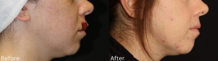Before & After Scar Therapy Case 232 View 3 View in Santa Rosa, California