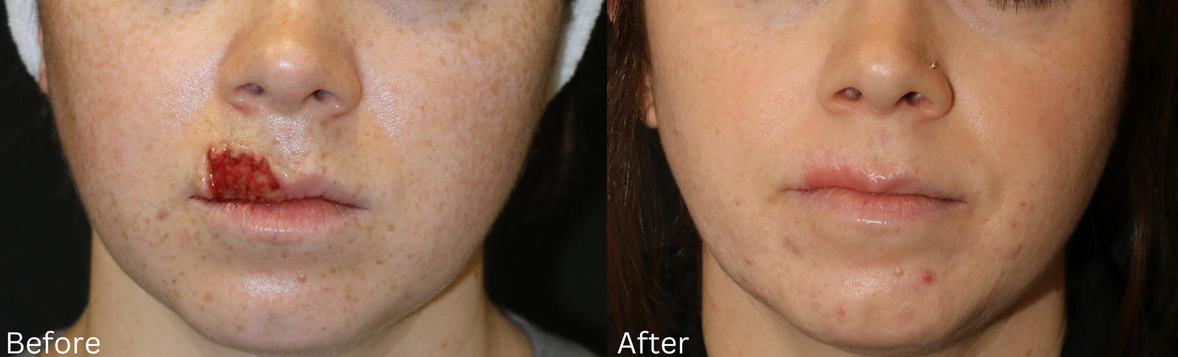 Before & After Scar Therapy Case 232 View 4 View in Santa Rosa, California