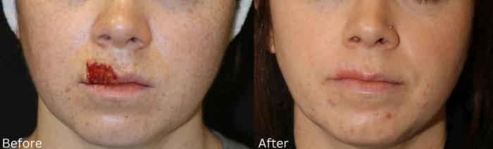 Before & After Scar Therapy Case 232 View 4 View in Santa Rosa, California
