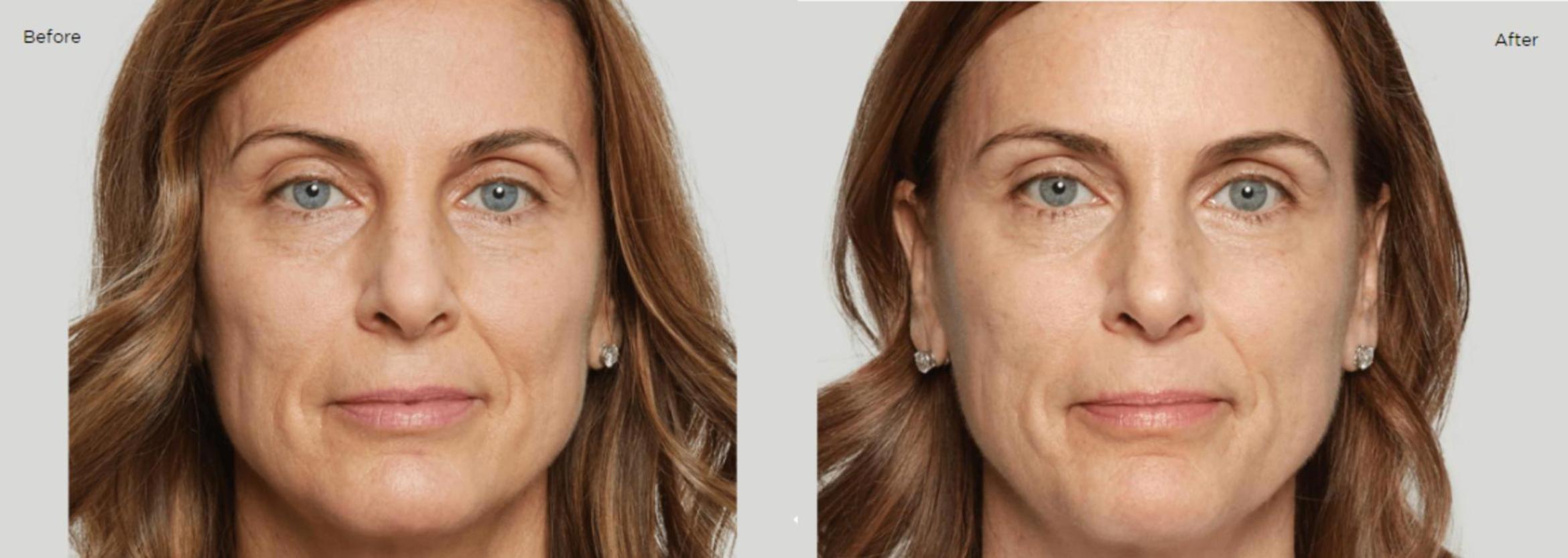Before & After Sculptra Case 204 View 1 View in Santa Rosa, California